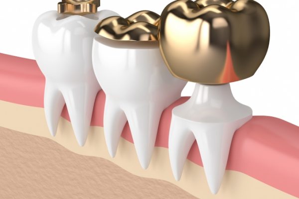 Treatment Inlays and Onlays