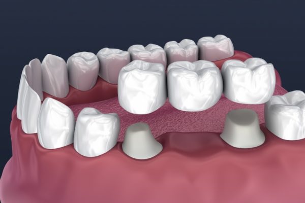 Treatment Bridges
