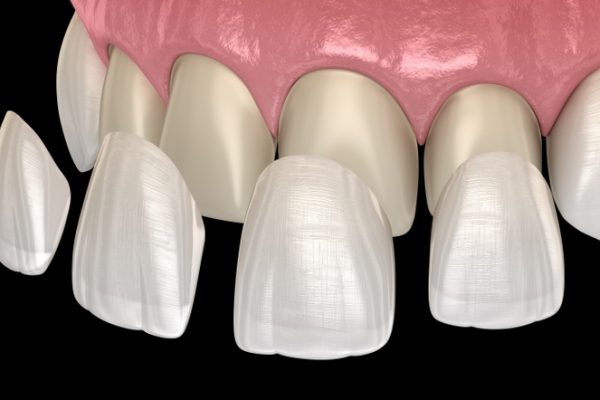 Treatment Veneers