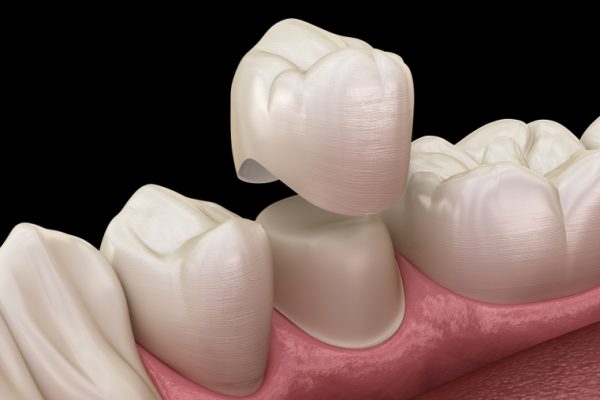 Treatment Crowns