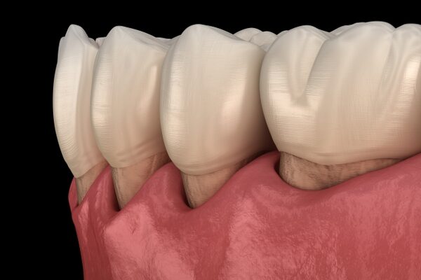 Treatment Periodontal Care