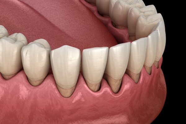 Treatment Gum Recession Treatment