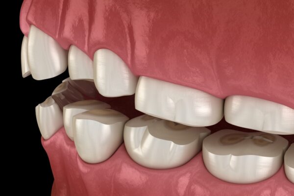 Treatment Bruxism