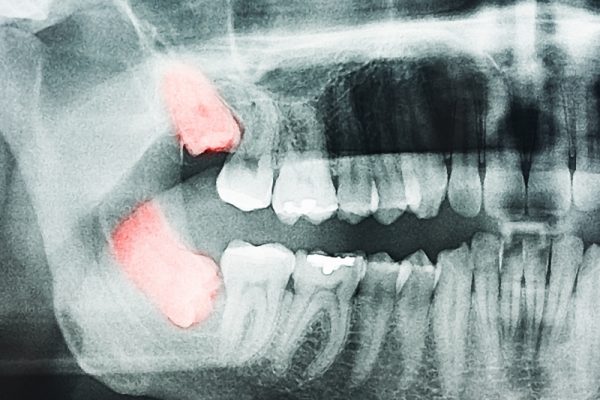 Treatment Tooth Extraction
