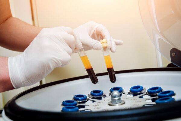 Treatment PRP