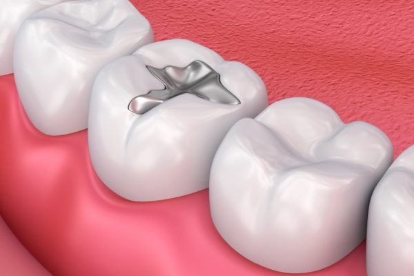 Treatment Fillings