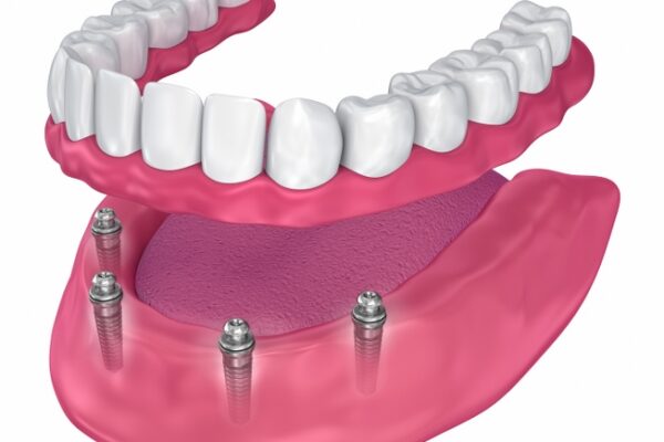 Treatment All-on-Four/All-on-Six Same Day Teeth