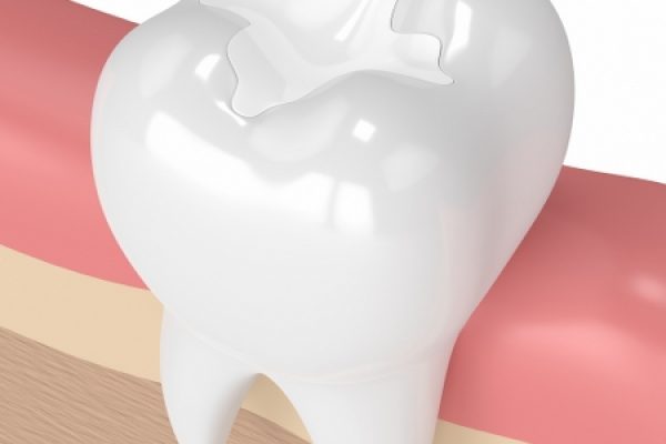 Treatment White Fillings